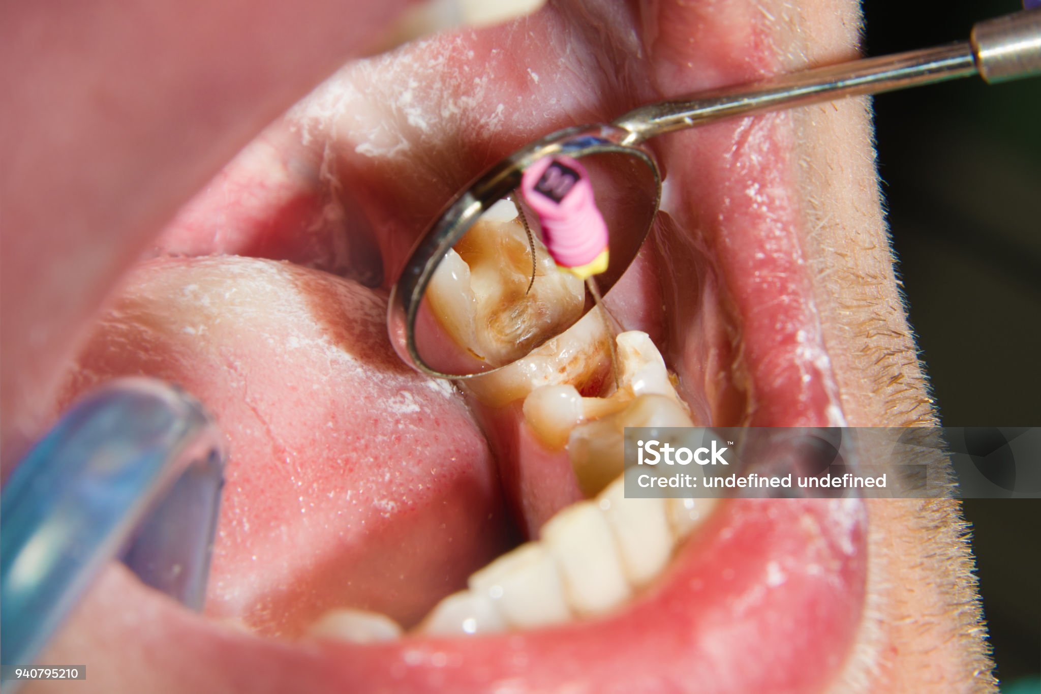 Root Canal at Dr. Dhanshree's Dental Clinic